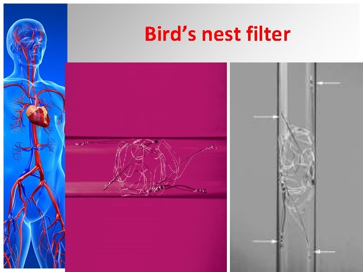 Bird’s nest filter 