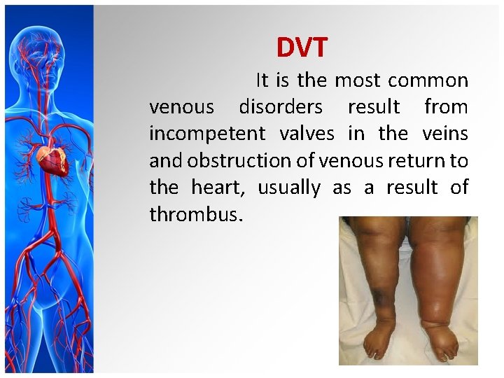 DVT It is the most common venous disorders result from incompetent valves in the