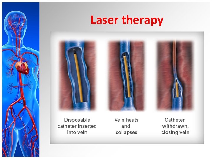 Laser therapy 