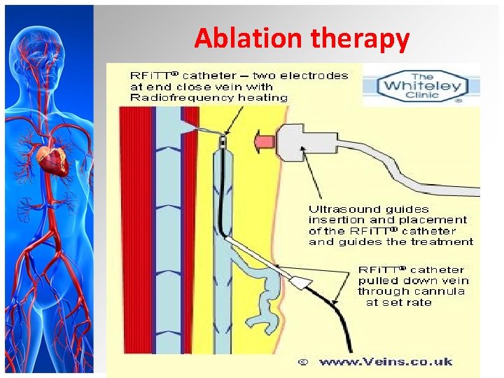 Ablation therapy 