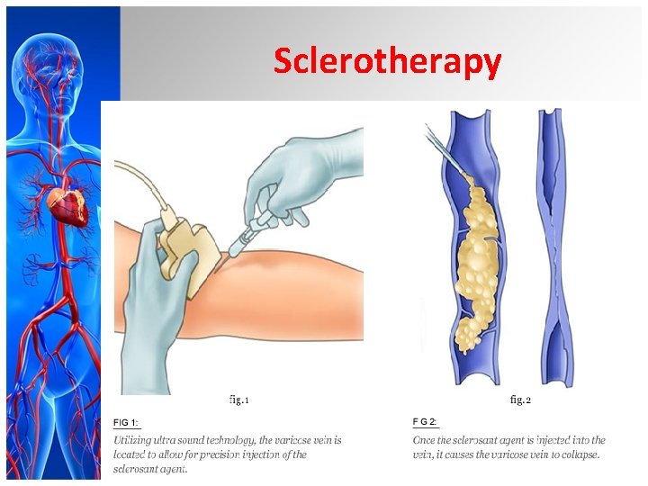 Sclerotherapy 