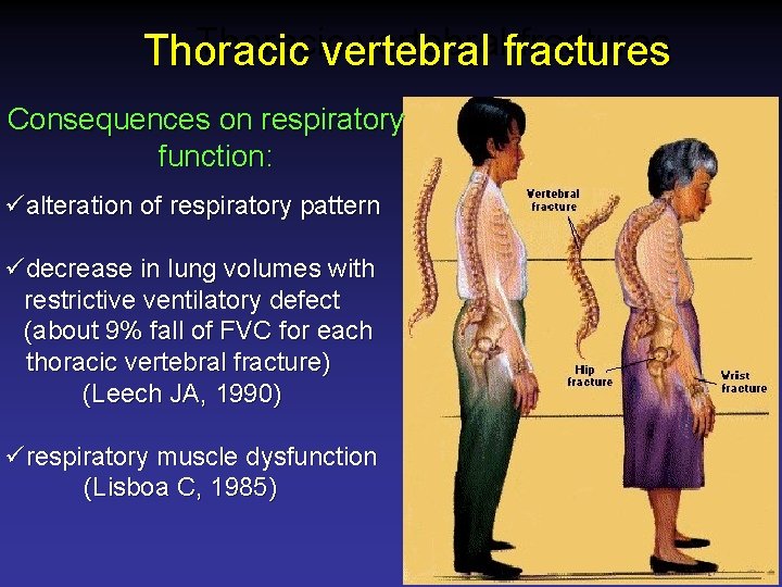 Thoracic vertebralfractures Thoracic vertebral Consequences on respiratory function: üalteration of respiratory pattern üdecrease in