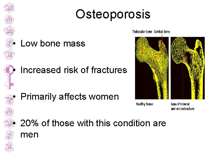 Osteoporosis • Low bone mass • Increased risk of fractures • Primarily affects women