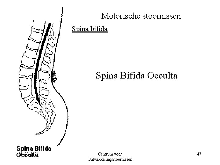 Motorische stoornissen Spina bifida Spina Bifida Occulta 08 -03 -2001 Centrum voor Ontwikkelingsstoornissen 47