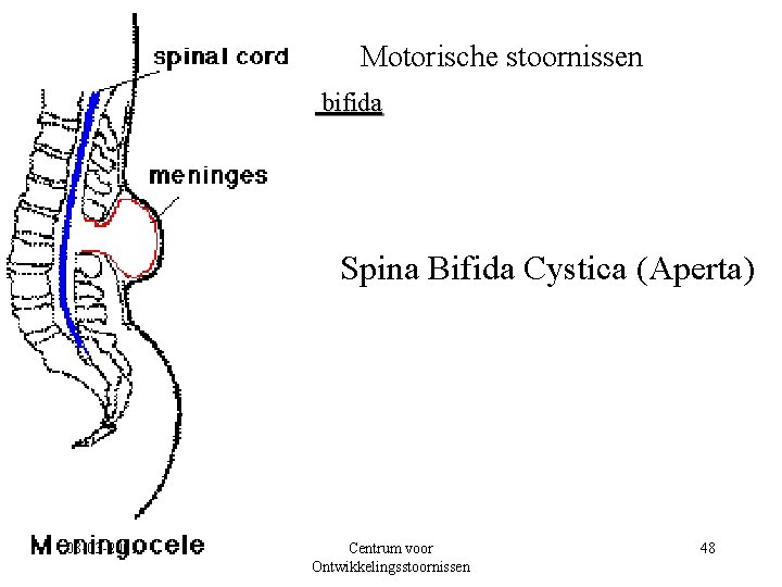 Motorische stoornissen Spina bifida Spina Bifida Cystica (Aperta) 08 -03 -2001 Centrum voor Ontwikkelingsstoornissen