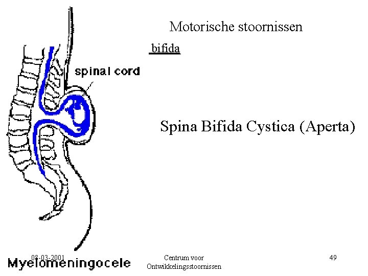 Motorische stoornissen Spina bifida Spina Bifida Cystica (Aperta) 08 -03 -2001 Centrum voor Ontwikkelingsstoornissen