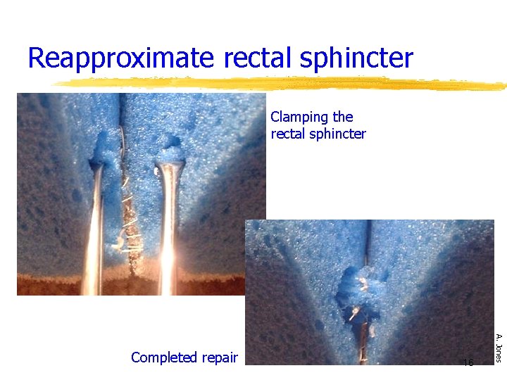 Reapproximate rectal sphincter Clamping the rectal sphincter 16 A. Jones Completed repair 