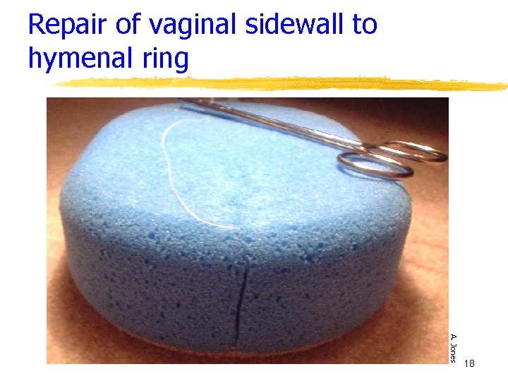 Repair of vaginal sidewall to hymenal ring A. Jones 18 