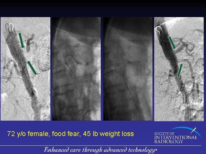 72 y/o female, food fear, 45 lb weight loss 