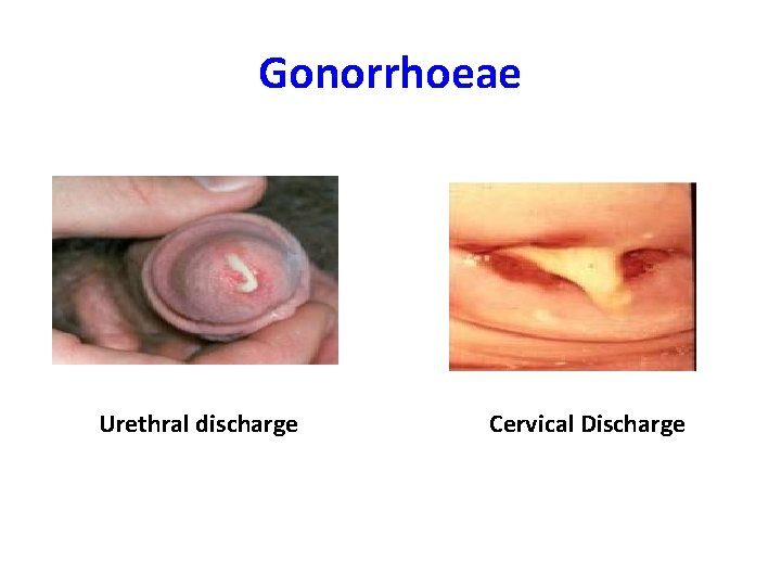 Gonorrhoeae Urethral discharge Cervical Discharge 