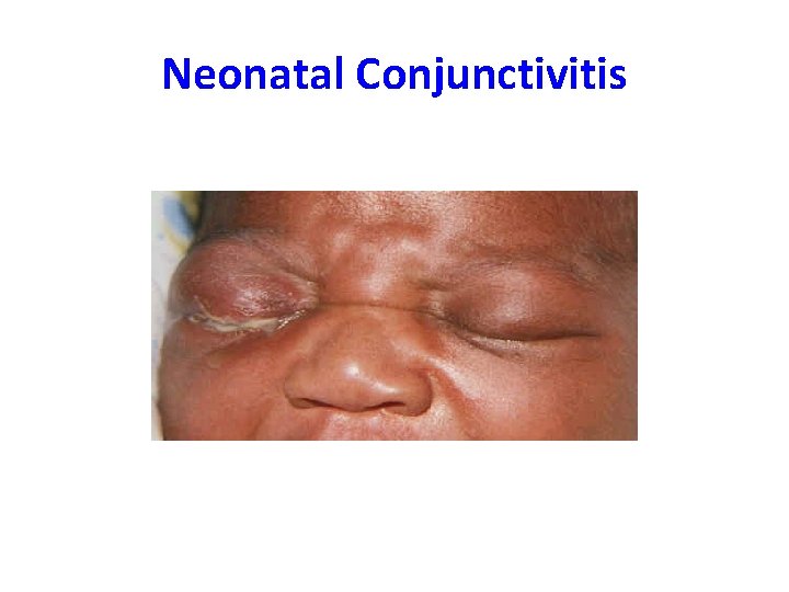 Neonatal Conjunctivitis 