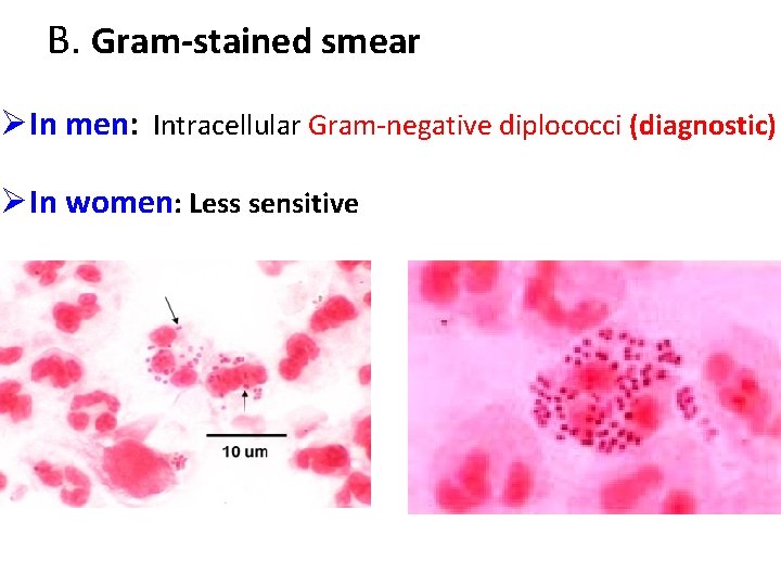 B. Gram-stained smear ØIn men: Intracellular Gram-negative diplococci (diagnostic) ØIn women: Less sensitive 