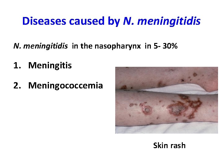 Diseases caused by N. meningitidis in the nasopharynx in 5 - 30% 1. Meningitis