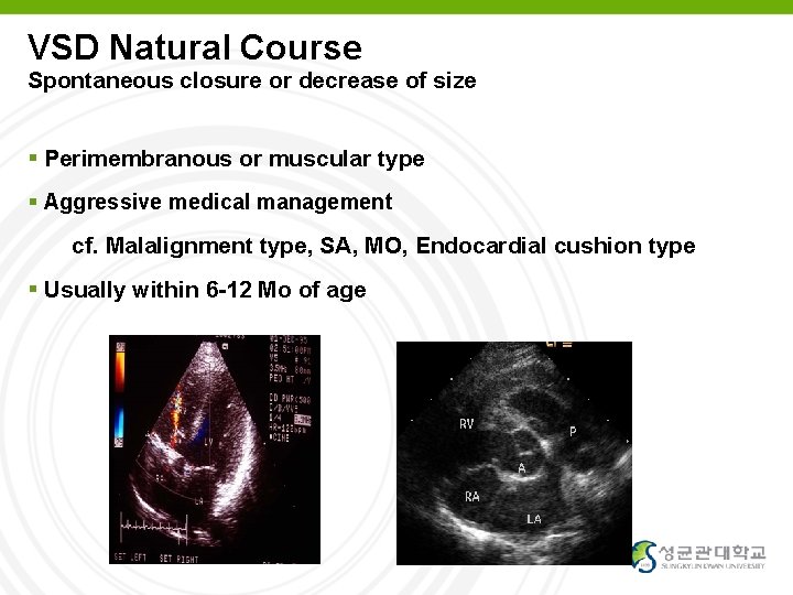 VSD Natural Course Spontaneous closure or decrease of size Perimembranous or muscular type Aggressive
