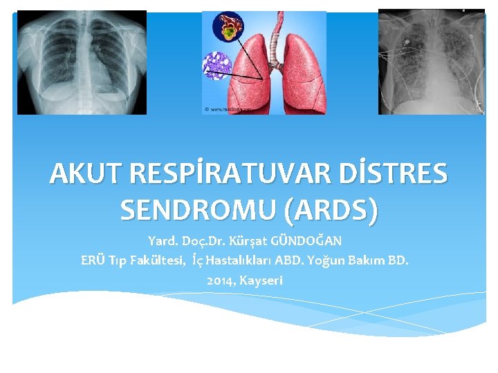 AKUT RESPİRATUVAR DİSTRES SENDROMU (ARDS) Yard. Doç. Dr. Kürşat GÜNDOĞAN ERÜ Tıp Fakültesi, İç AKUT RESPİRATUVAR DİSTRES SENDROMU (ARDS) Yard. Doç. Dr. Kürşat GÜNDOĞAN ERÜ Tıp Fakültesi, İç