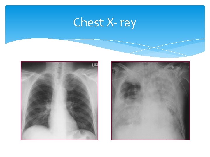 Chest X- ray Chest X- ray