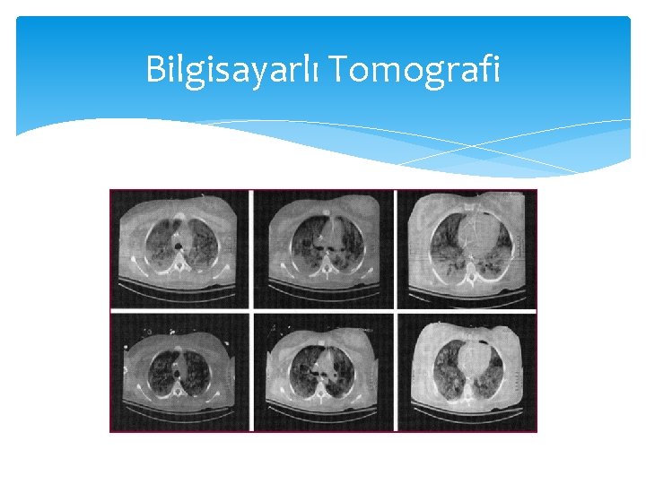 Bilgisayarlı Tomografi Bilgisayarlı Tomografi