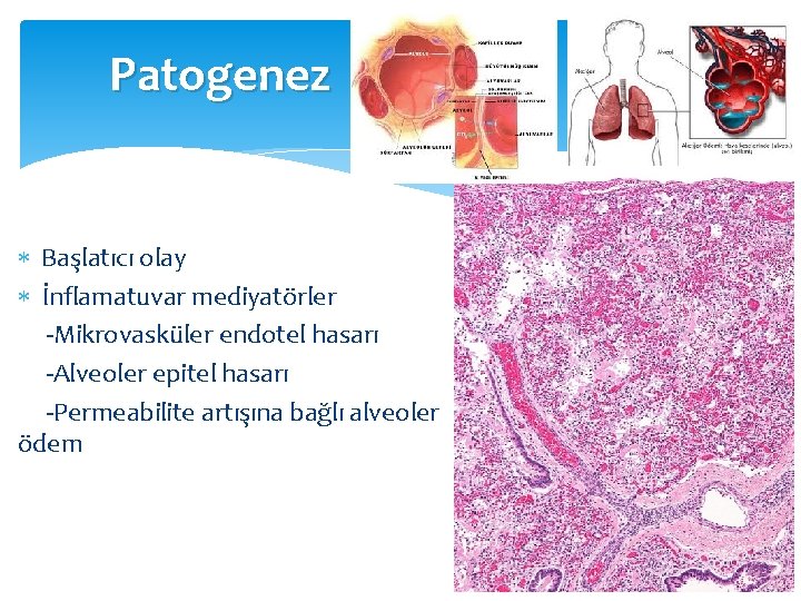 Patogenez Başlatıcı olay İnflamatuvar mediyatörler -Mikrovasküler endotel hasarı -Alveoler epitel hasarı -Permeabilite artışına bağlı Patogenez Başlatıcı olay İnflamatuvar mediyatörler -Mikrovasküler endotel hasarı -Alveoler epitel hasarı -Permeabilite artışına bağlı