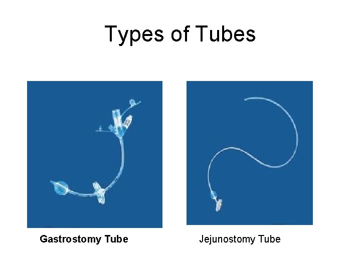 Types of Tubes Gastrostomy Tube Jejunostomy Tube 