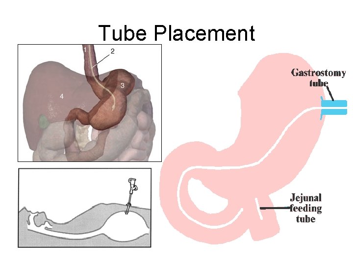 Tube Placement 