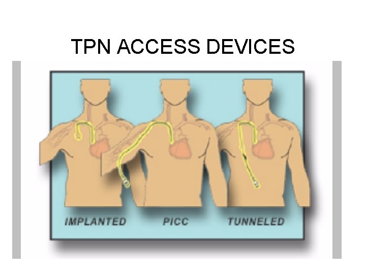 TPN ACCESS DEVICES 