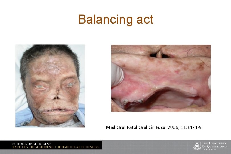 Balancing act Med Oral Patol Oral Cir Bucal 2006; 11: E 474 -9 
