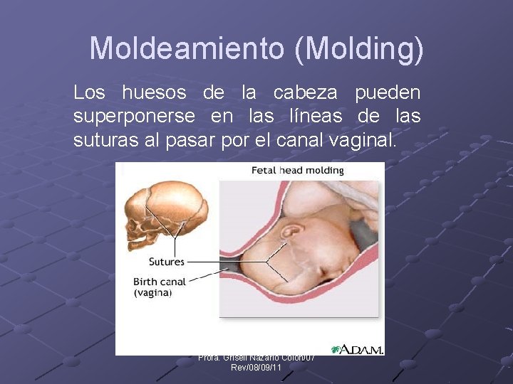 Moldeamiento (Molding) Los huesos de la cabeza pueden superponerse en las líneas de las