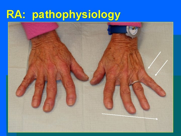 RA: pathophysiology RA: pathophysiology