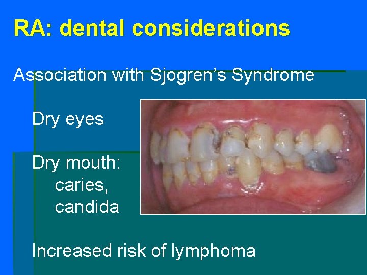 RA: dental considerations Association with Sjogren’s Syndrome Dry eyes Dry mouth: caries, candida Increased RA: dental considerations Association with Sjogren’s Syndrome Dry eyes Dry mouth: caries, candida Increased