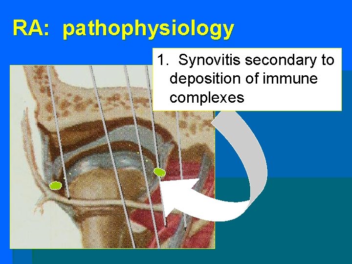RA: pathophysiology 1. Synovitis secondary to deposition of immune complexes RA: pathophysiology 1. Synovitis secondary to deposition of immune complexes
