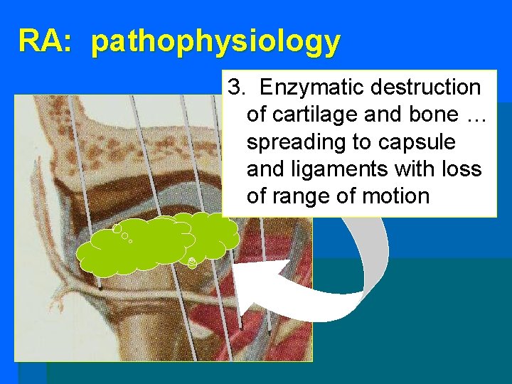 RA: pathophysiology 3. Enzymatic destruction of cartilage and bone … spreading to capsule and RA: pathophysiology 3. Enzymatic destruction of cartilage and bone … spreading to capsule and