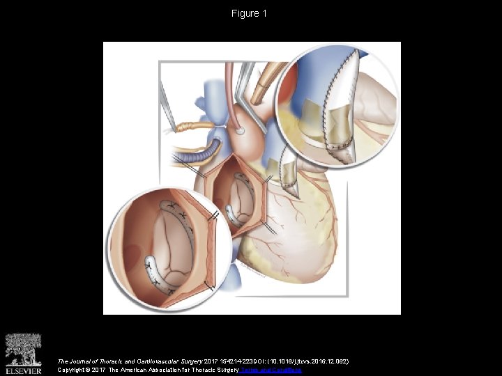 Figure 1 The Journal of Thoracic and Cardiovascular Surgery 2017 154214 -223 DOI: (10.