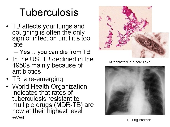 Tuberculosis • TB affects your lungs and coughing is often the only sign of