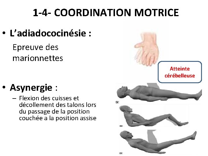 1 -4 - COORDINATION MOTRICE • L’adiadococinésie : Epreuve des marionnettes Atteinte cérébelleuse •