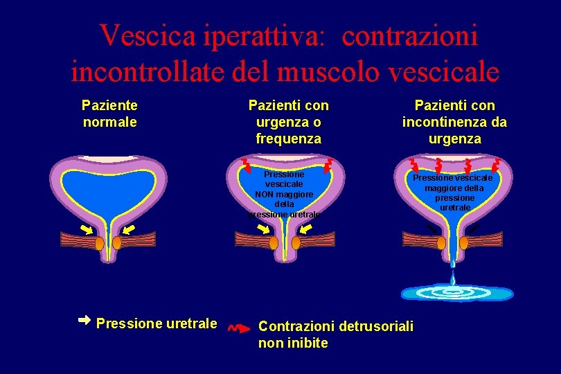 Vescica iperattiva: contrazioni incontrollate del muscolo vescicale Paziente normale Pazienti con urgenza o frequenza