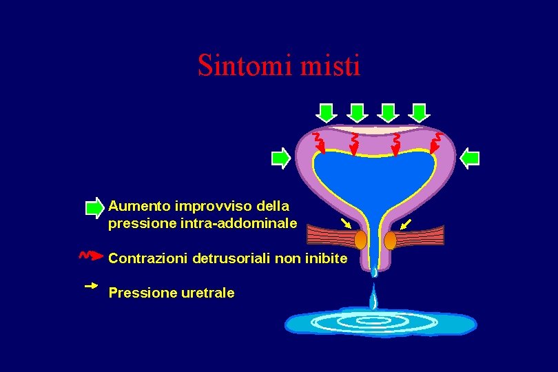 Sintomi misti Aumento improvviso della pressione intra-addominale Contrazioni detrusoriali non inibite Pressione uretrale 