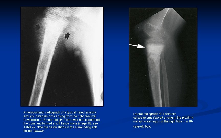 Anteroposterior radiograph of a typical mixed sclerotic and lytic osteosarcoma arising from the right