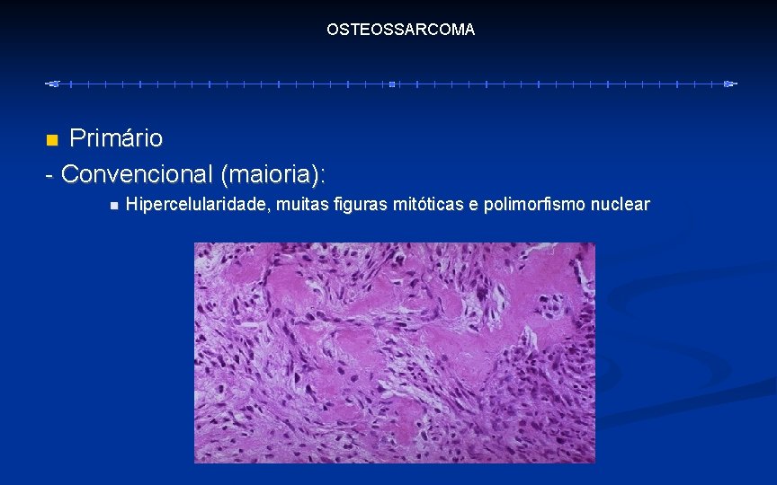 OSTEOSSARCOMA Primário - Convencional (maioria): Hipercelularidade, muitas figuras mitóticas e polimorfismo nuclear 