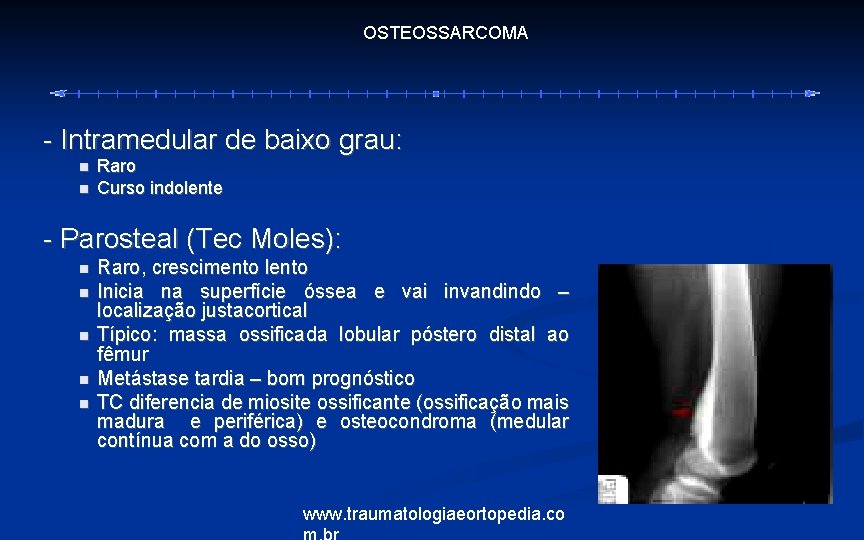 OSTEOSSARCOMA - Intramedular de baixo grau: Raro Curso indolente - Parosteal (Tec Moles): Raro,