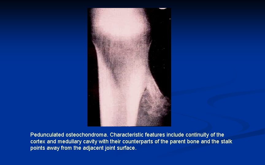 Pedunculated osteochondroma. Characteristic features include continuity of the cortex and medullary cavity with their