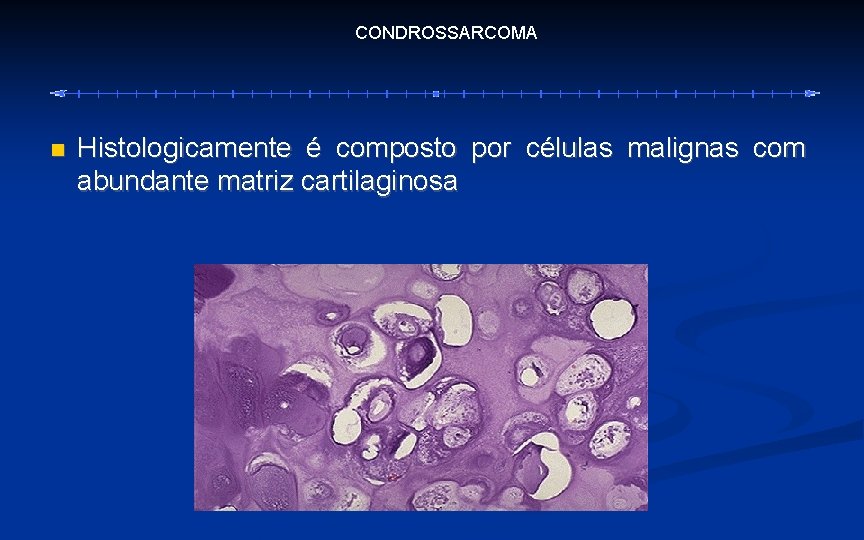 CONDROSSARCOMA Histologicamente é composto por células malignas com abundante matriz cartilaginosa 