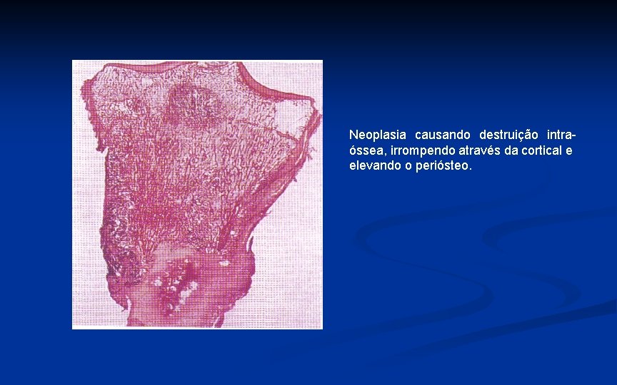 Neoplasia causando destruição intraóssea, irrompendo através da cortical e elevando o periósteo. 