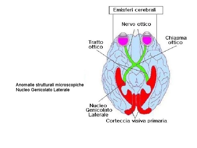 Anomalie strutturali microscopiche Nucleo Genicolato Laterale 