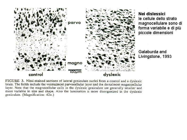 Nei dislessici le cellule dello strato magnocellulare sono di forma variabile e di più
