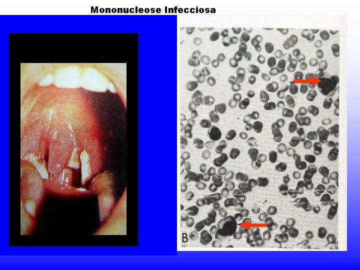 Mononucleose Infecciosa 