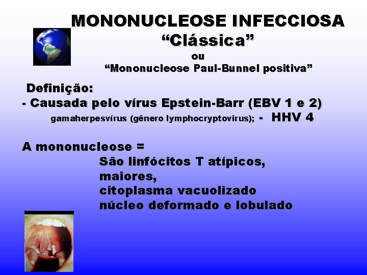 MONONUCLEOSE INFECCIOSA “Clássica” ou “Mononucleose Paul-Bunnel positiva” Definição: - Causada pelo vírus Epstein-Barr (EBV