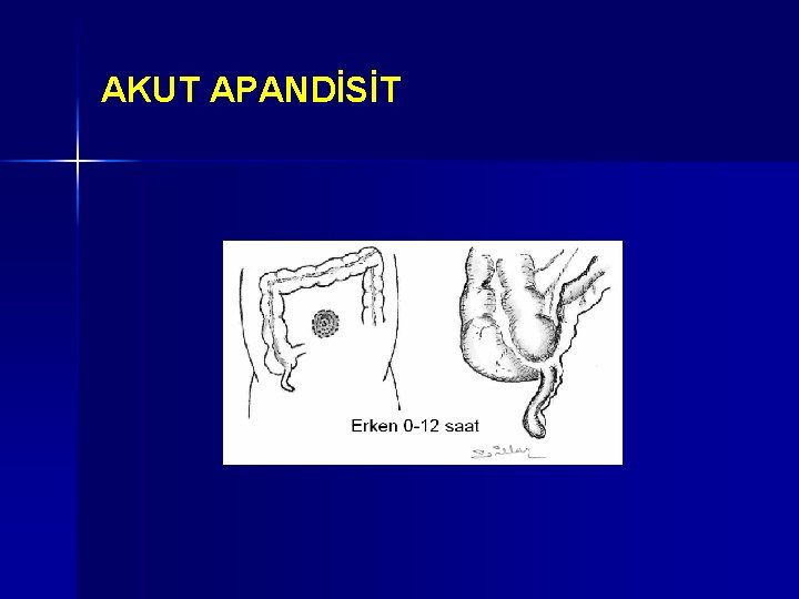 AKUT APANDİSİT AKUT APANDİSİT