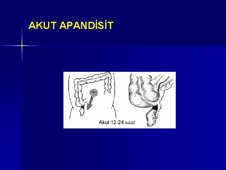 AKUT APANDİSİT AKUT APANDİSİT