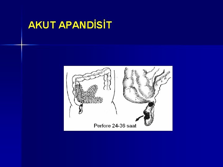 AKUT APANDİSİT AKUT APANDİSİT
