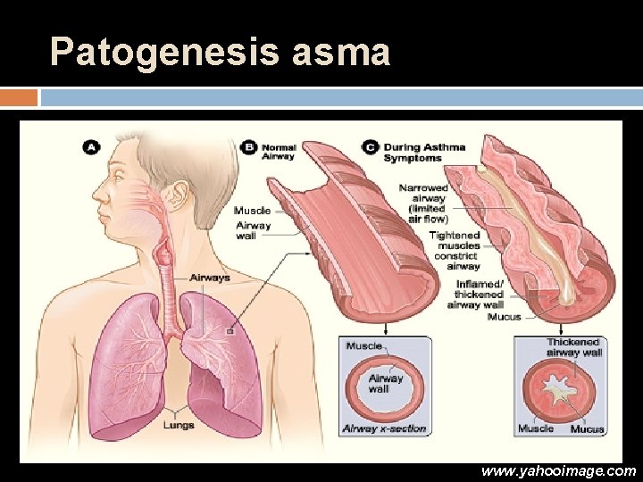 Patogenesis asma www. yahooimage. com 